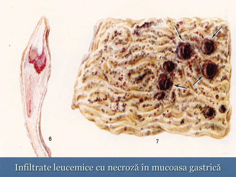 Infiltrate leucemice cu necroză în mucoasa gastrică